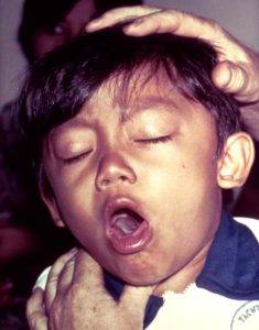bacterial infection
