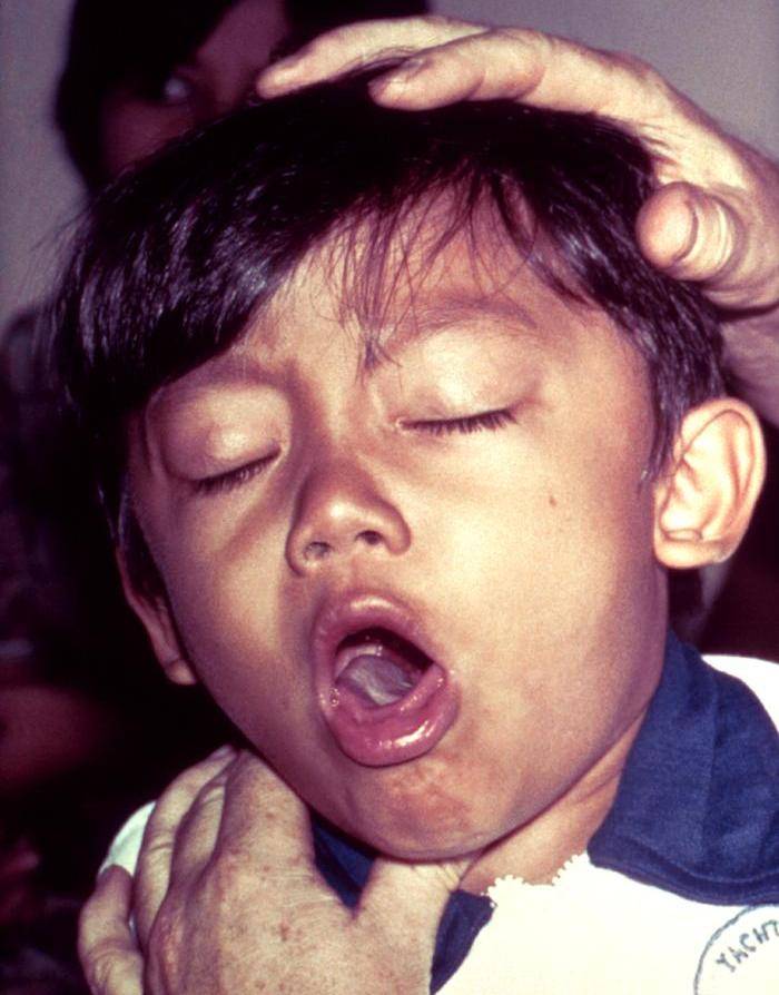 bacterial infection