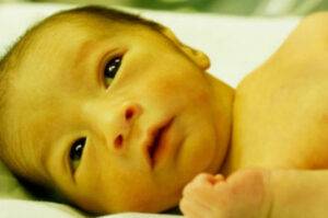 Jaundice: Navigating the Yellow Warning Sign in Newborns 3 Newborn-jaundice-eyes