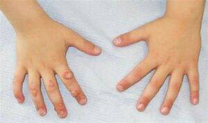 Warts