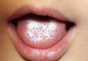 oral-thrush