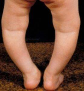 rickets