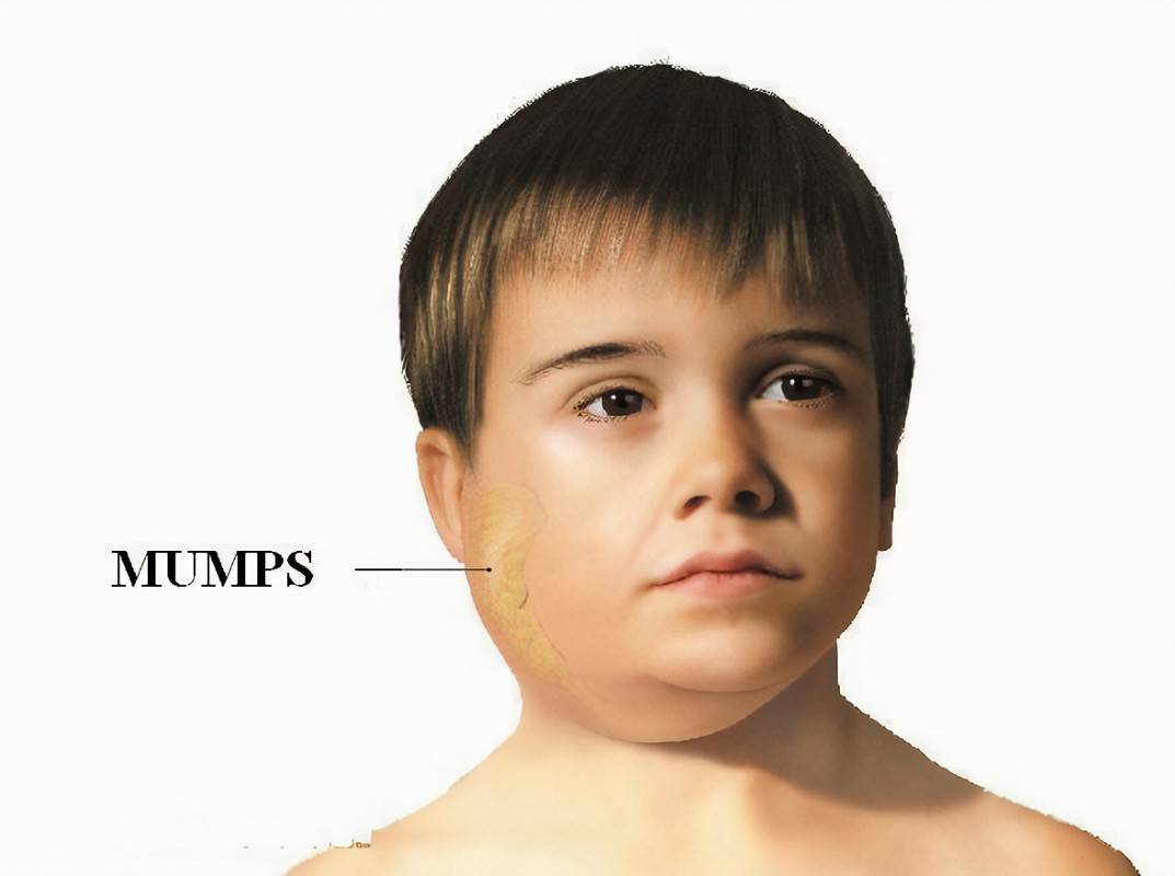 Mumps in children