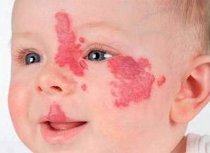 Hemangioma: Demystifying the Common Birthmark in Children 2 Hemangioma