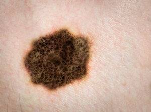 Dramatic picture of a malignant mole (melanoma, skin cancer). The picture was taken using a Dermatoscope, a special instrument used in Dermatology.