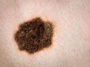 Melanoma Watch: A Parent's Vigilant Approach to Sun Safety for Children 6 Dramatic picture of a malignant mole (melanoma, skin cancer). The picture was taken using a Dermatoscope, a special instrument used in Dermatology.