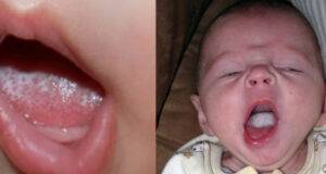 oral-thrush