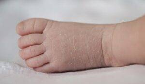 The Battle Against Xerosis: Unveiling the Secrets of Managing Abnormally Dry Skin in Children 5 Xerosis in children