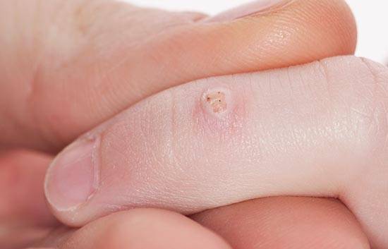 warts in children