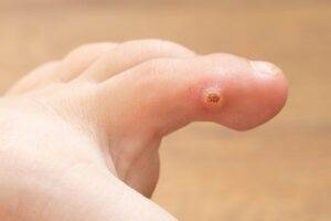 The Stubborn Reality of Warts: A Comprehensive Guide for Parents to Understand and Combat Skin Growths in Children 8 warts in children