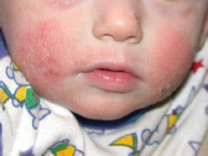 Atopic Dermatitis: Navigating the World of Childhood Eczema