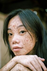 rashes