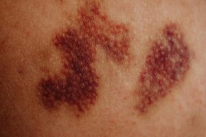 severe vaccine reaction